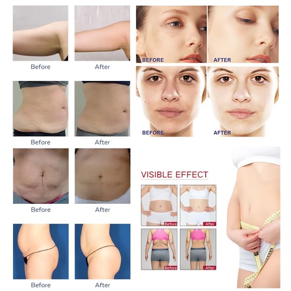 RF Non Invasive Body Sculpting Machine For Cellulite Treatment