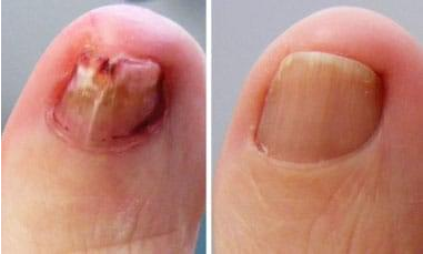 Berylas Podiatry Laser 1064nm Onychomycosis Laser Treatment