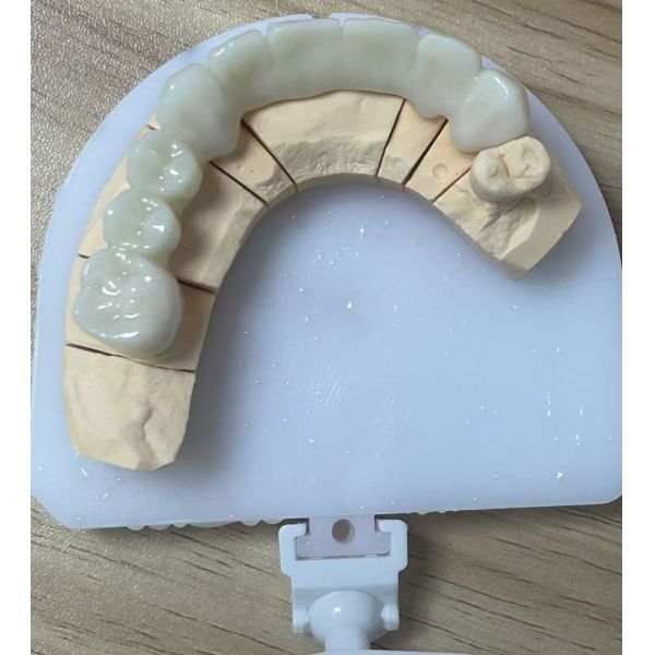 Full Zirconia dental bridge for high strength and durable dental restoration