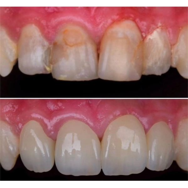 Yucera 4D Pro Zirconia Blocks the Choice for High-Quality Dental Restorations