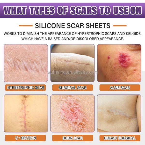 Custom Graphics Silicone Scar Patch Medical Grade Fade Resistant Scar Removal Sheets