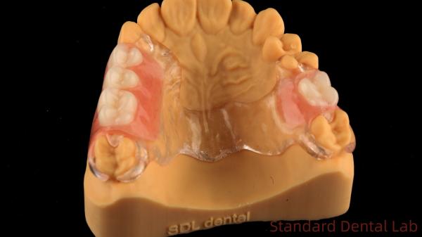 Estrutura de metal fundido transparente flexível Dentes parciais Alta estética Perfeito ajuste
