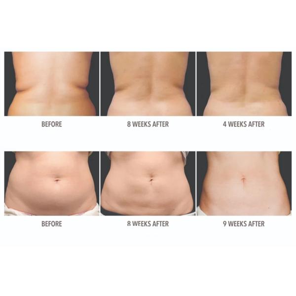 Уменьшение тела решения липолиза Kabelline