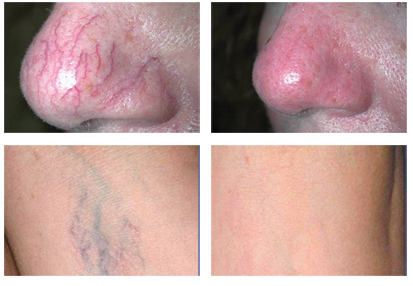 1064nm wavelengths 755nm permanent hair removal machine