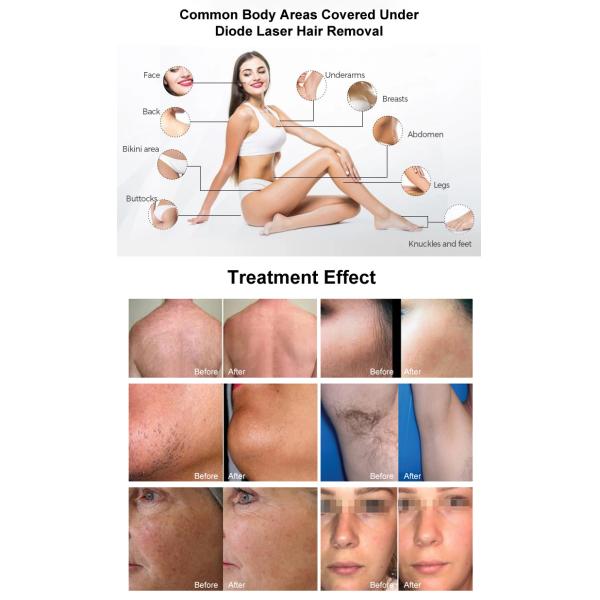 4 Wave Length 790 940 808 1060nm Diode Laser Hair Removal Machine For Women