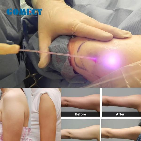 2024 Newest Endolaser 1470nm 980nm Diode Laser Face Lifting Liposuction Machine