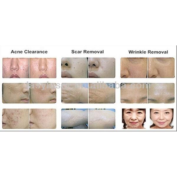 Машины лазера СО2 эрбия дерматологии машина лазера подмолаживания кожи частичной влагалищная