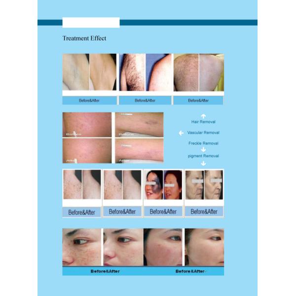 Multifunctional OPT IPL RF ND YAG Laser Machine Hair Removal With 15 Inch Touch Screen