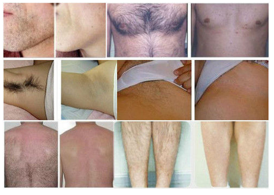 Permanent 808nm Diode Laser Hair Removal Machine For Chest / Armpit