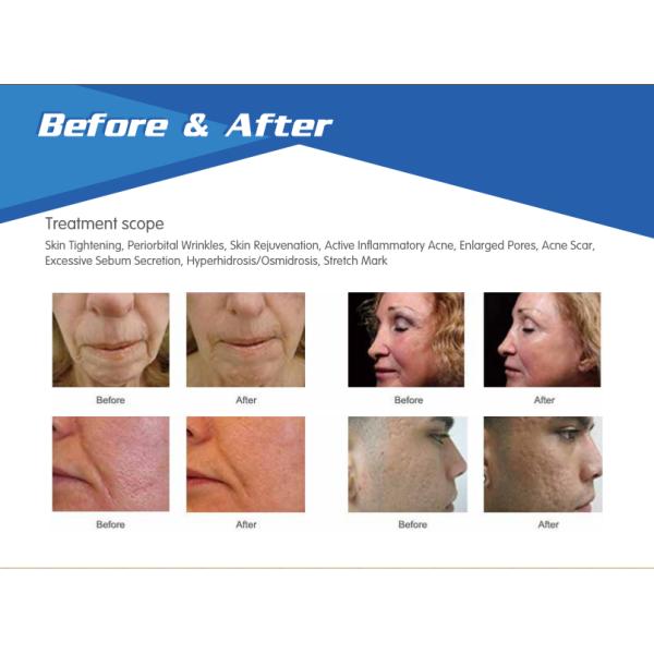 2019 New model Vertical Fractional RF Micro Needle  and No needle equipment 80W RF output power 5Mhz frequency