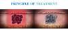 Hot sell best new laser fda approved equipment picosecond laser remove tattoo