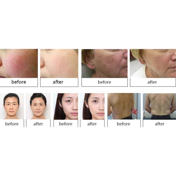 Permanent SHR Hair Removal Machine AC 230V ± 10% Power Supply ISO9001