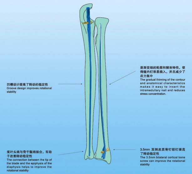 Система ногтя радиуса Ulna интрамедуллярная блокируя ноготь IM имплантирует