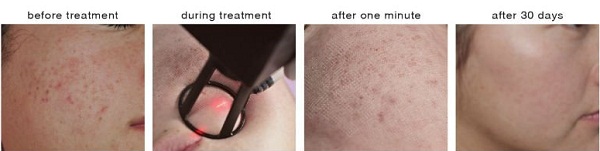 40W RF Laser Beauty Machine Pigment Removal And Acne Treatment