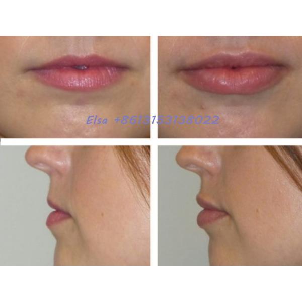 заполнитель Voluma Ultra3 губы 24mg/Ml DermalJuvederm