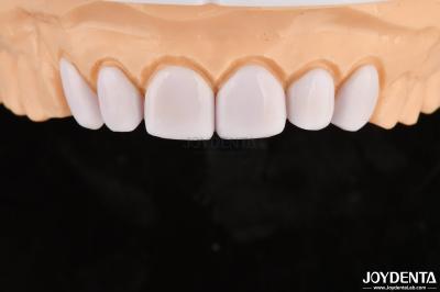 Dental Veneers for Misaligned Teeth Biocompatibility And Gentle On Oral Tissues