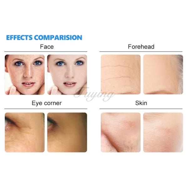 Ready Ship 2in1 Deep Cleaning Microdermabrasion Peel Hydra Dermabrasion Machine Oxygen Spray Facial Machine