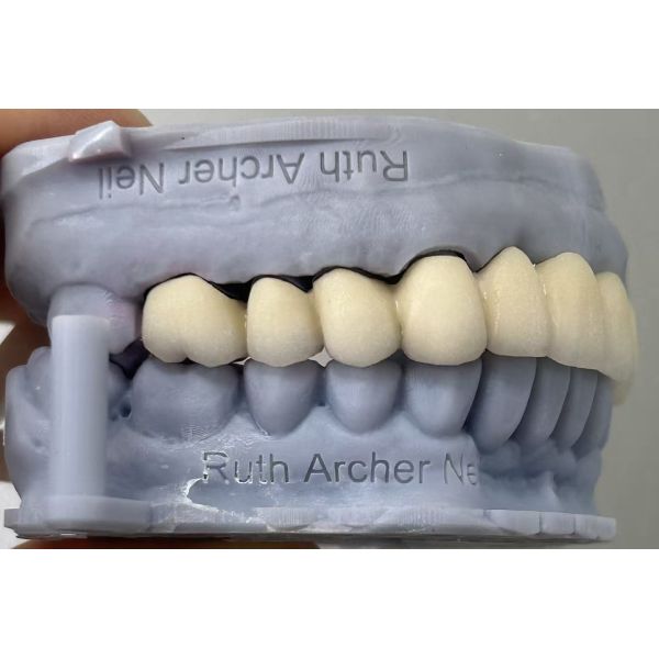 Semi-precious Porcelain Fused to Metal Dental Bridge for Durable Dental Restoration