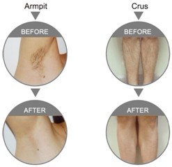 Efficiency Diode Medical Laser Equipment For Hair Removal / Acne Pigmentation Removal