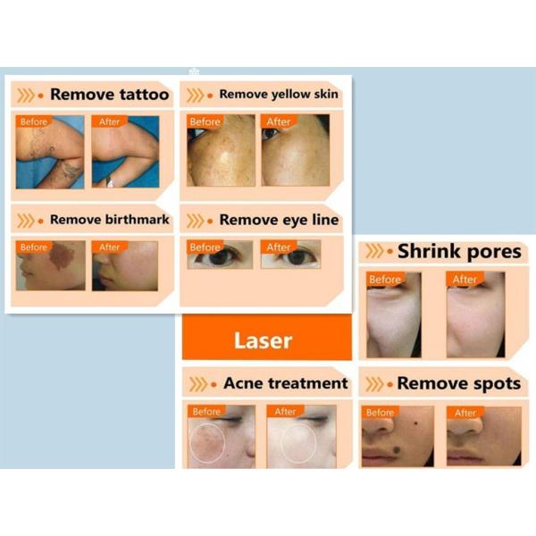 Beauty Salon Use Nd Yag Laser Tattoo Removal Machine for Eyebrow Removal