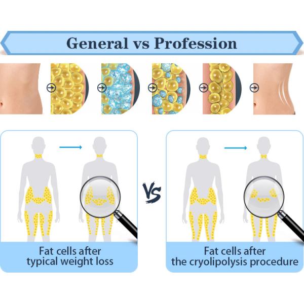 3d lipo fat freezing advanced lipo non invasive laser treatments cavi lipo machines for sale