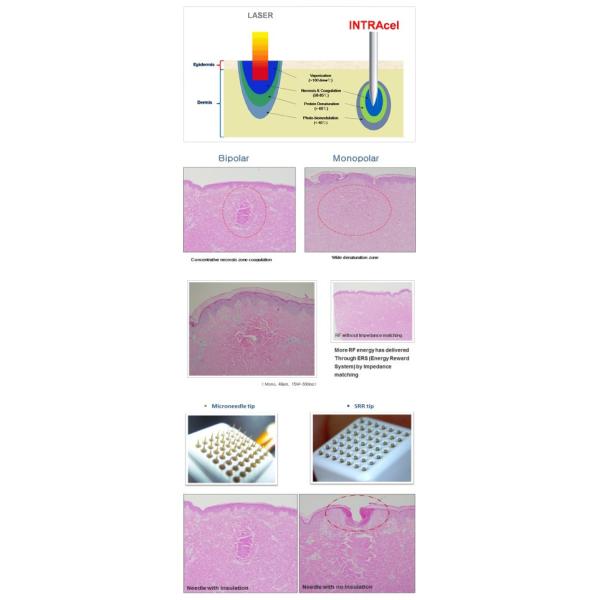 Manufacturer supply 2Mhz portable fractional RF micro needle machine for Wrinkle removal Facial wrinkle removal
