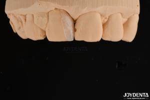 Thin Shell Micro Veneer Cosmetic Dental Treatment Micro Thin Teeth Veneers