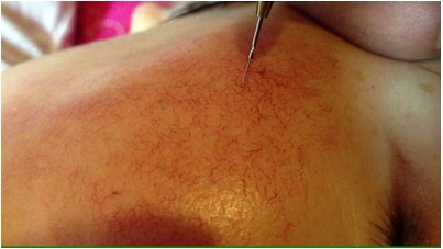 Easy operation professional skin tags warts varicose veins removal machine