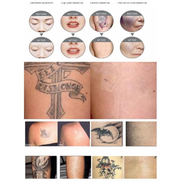 Portable 1064nm & 532nm Q Switch ND Yag Laser Tattoo Removal Machine