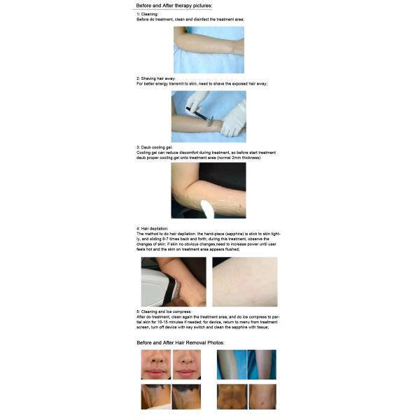 810nm Semiconductor Laser Hair Removal Machine Effective Remove Hair Follicle