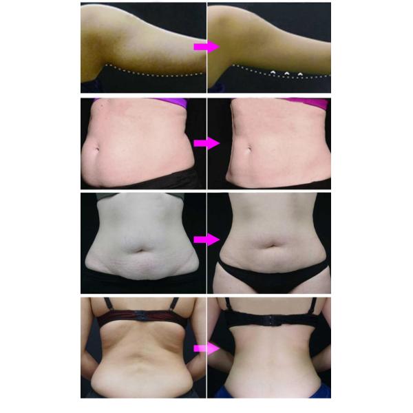 ISO90 1000W Cryolipolysis Slimming Machine Two Handle 6 Heads