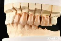 Bionic Development Leaves And Distinct Layers Of Zirconia All-Ceramic