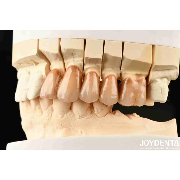 Bionic Teeth Layered Zirconia with Bionic Leaf Micro-Engraving and Multi-color Biomimetic Lamination for Advanced Light Simulation
