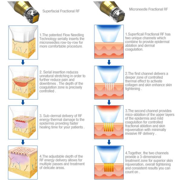 máquina de la elevación de cara del retiro de la cicatriz 5Mhz Microneedle RF