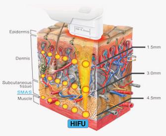 High Intensity Focused Ultrasound HIFU beauty   machine for Face Lifting and Wrinkle Removal