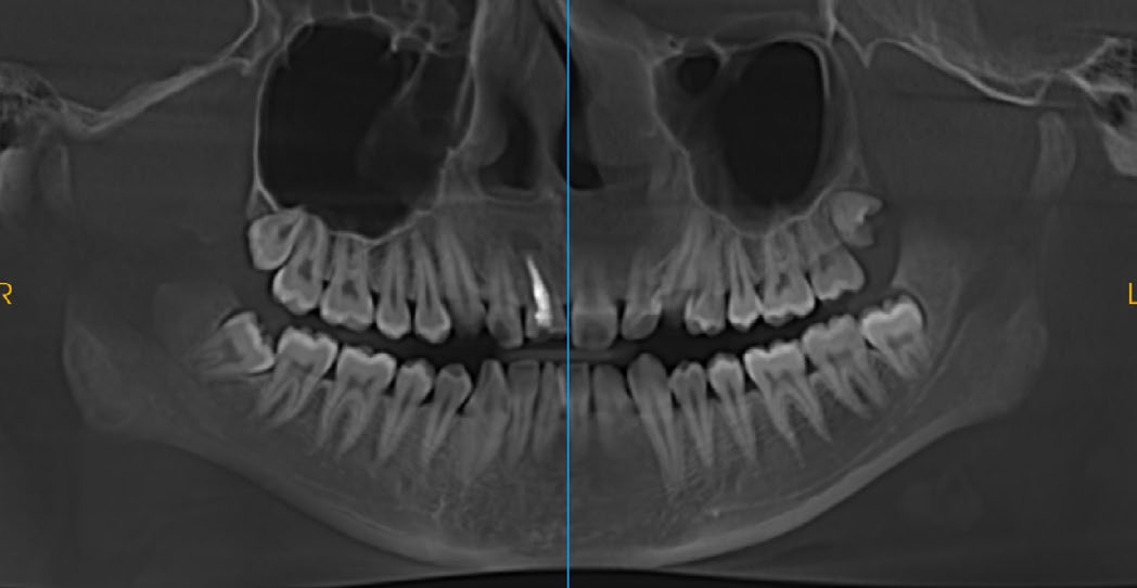 Dental Implant Orthodontic CBCT System High-Resolution 3D Imaging for Precise Diagnosis
