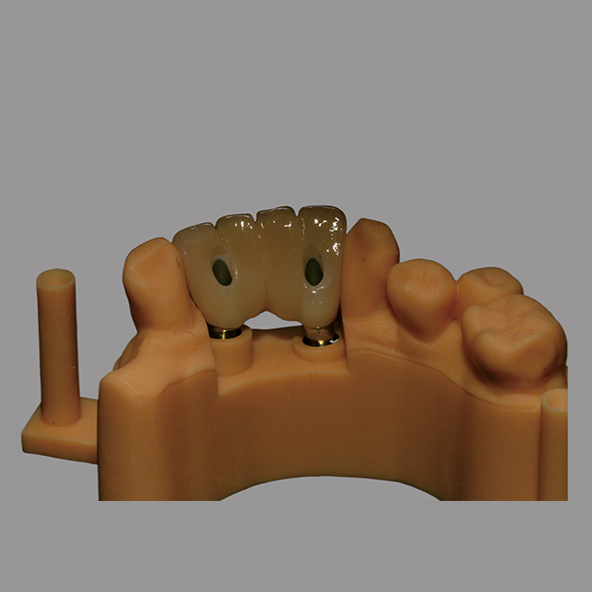 Gold Plating Nitrogen Titanium Abutments Dental Implants Cad/Cam Compatibility