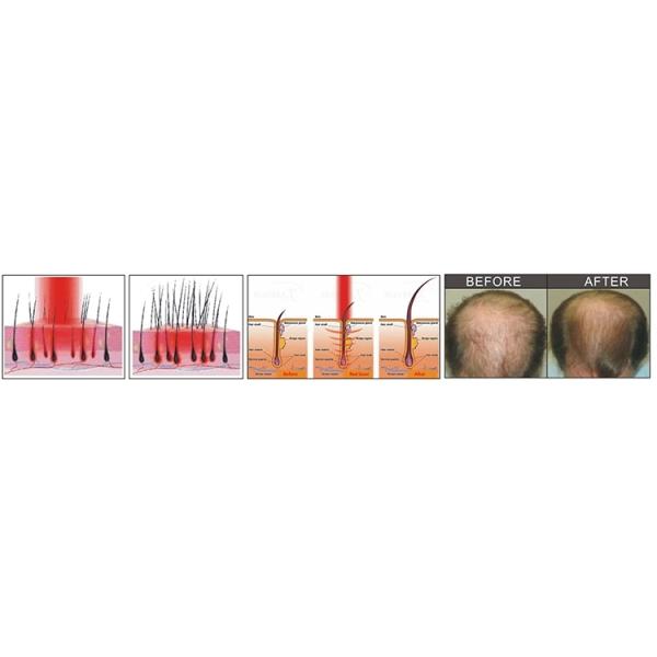 Diode Hair Loss Treatment Comb Laser Hair Growth 660nm