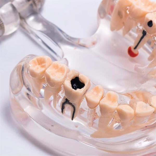 32 Tooth Full Month Implant Disease Teeth Model Clear Design  Dental Pathology Model