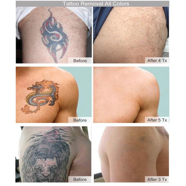 450ps Picolaser Q Switched Nd Yag Laser 1064nm 532nm Stationary