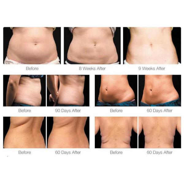 360 Cryolipolysis уменьшая прибор дренажа машины жирный замерзая лимфатический