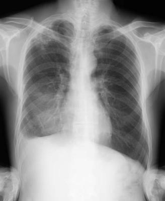 X-ray 14 x 17 Medical Dry Film , CT Fuji Medical Dry Imaging Film