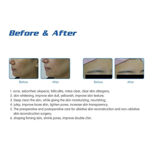 Skin Rejuvenation facial rejuvenation machine Hydra Dermabrasion machine