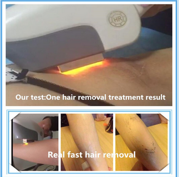 Professional Elight SHR Intense Pulsed Light Hair Removal Machine 1 - 10 HZ Frequency