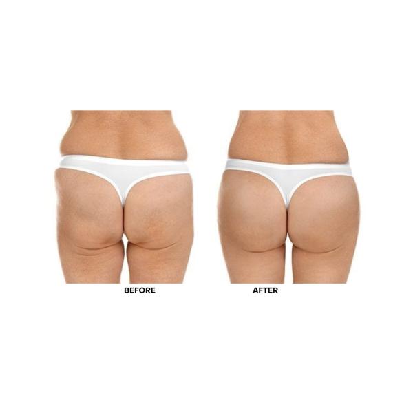 Hyaluronic Acid Breast Dermal Filler Breast Augmentation Buttock Lift Injection