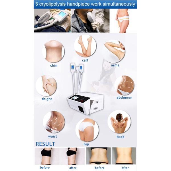 Жирная замерзая машина обработки целлюлита Crio