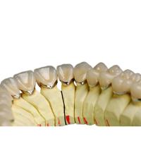 Dent naturelle de porcelaine en métal de laboratoire d'alliage de couronne dentaire titanique dentaire de porcelaine