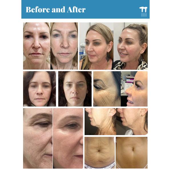 Appareil de rajeunissement de la peau par radiofréquence Équipement de lifting du visage non chirurgical AC220V 110V