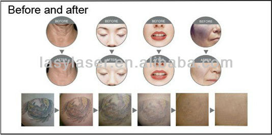 Elight SHR Pico Tattoo Removal Machine 220V Portable Nd Yag Laser