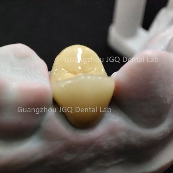 Custom Zirconia Restorations Professional Dental Lab for Global Dental Clinics